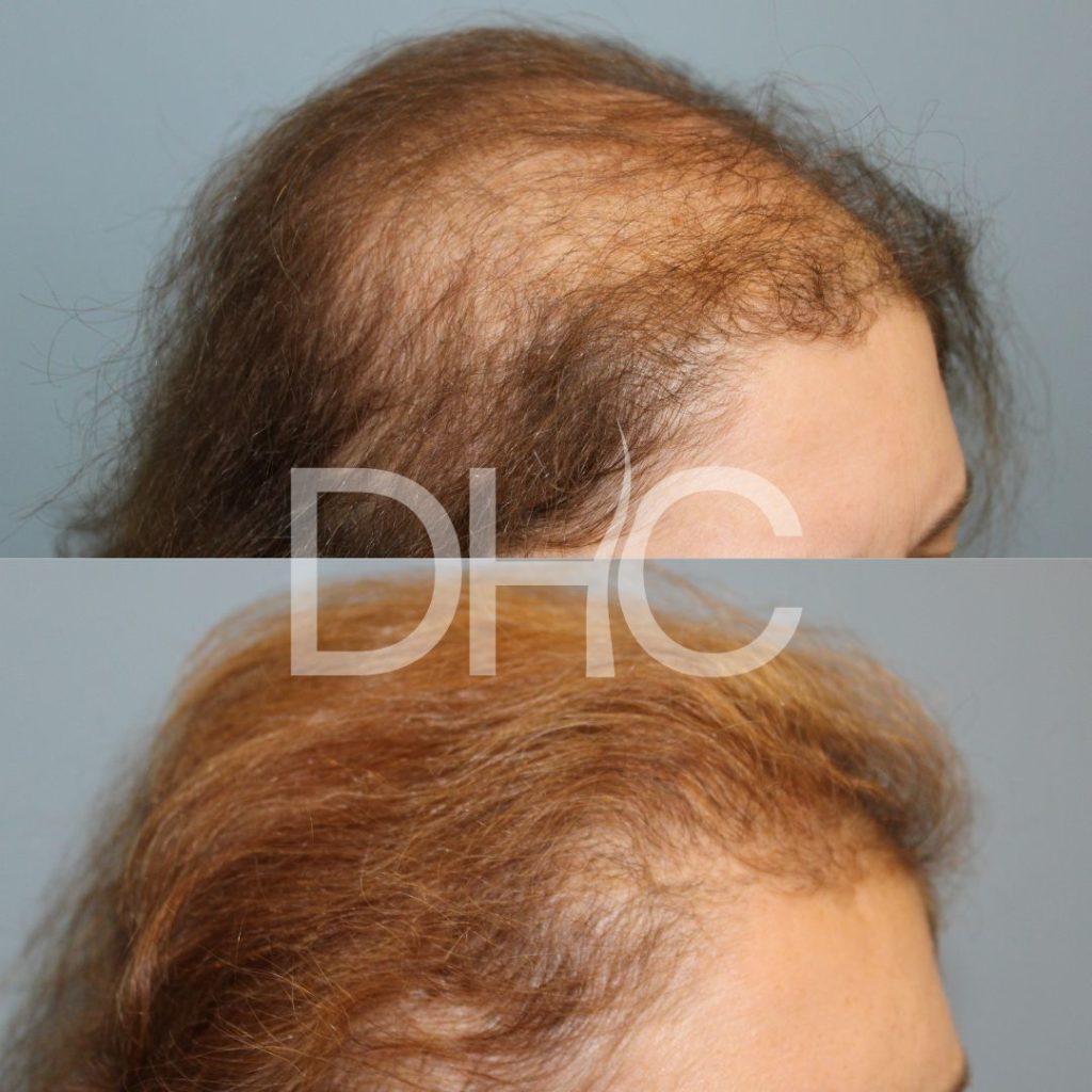 Direct Hair Clinic | DHC Thessaloniki