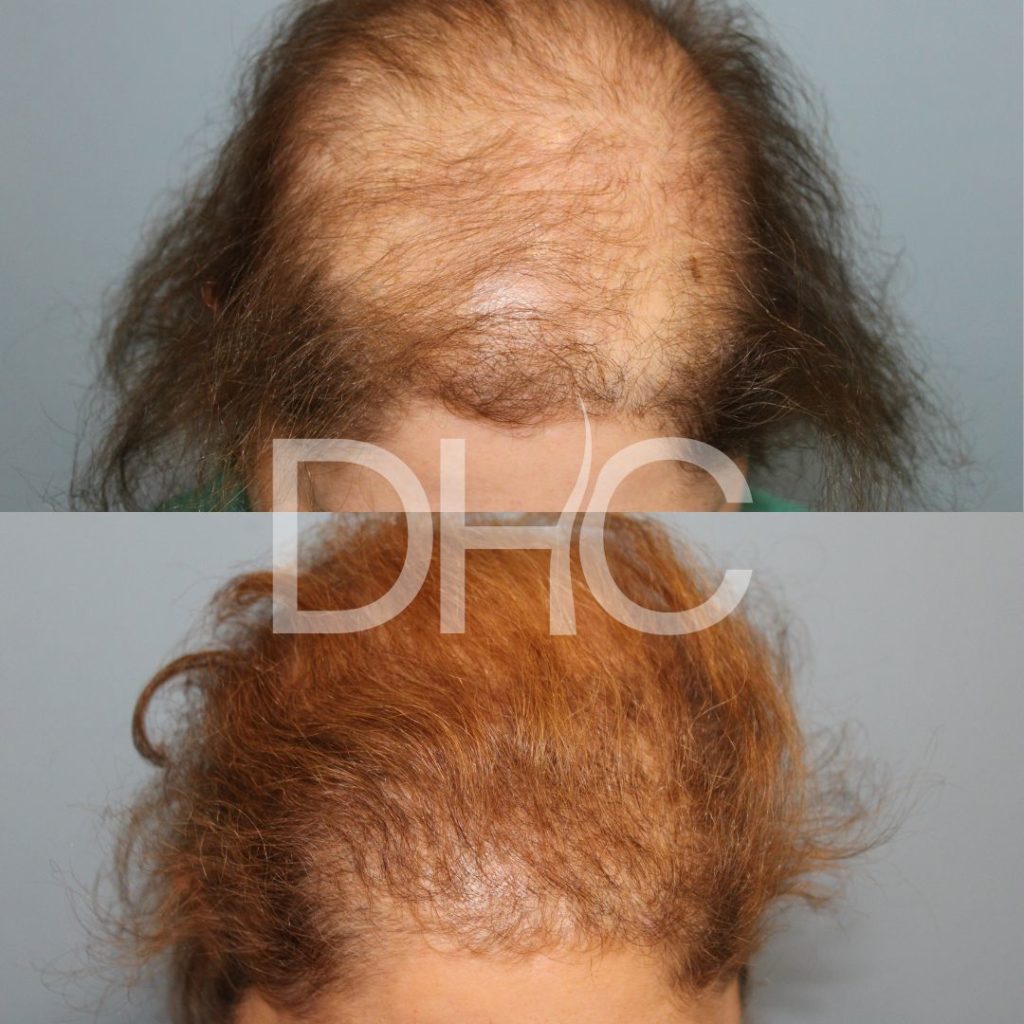 Direct Hair clinic | DHC Πριν μετά